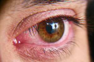 عدم مصرف مکمل های بینایی و خشکی چشم!
