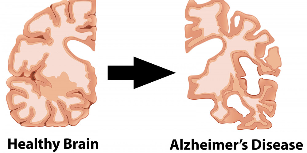 مراحل بیماری آلزایمر