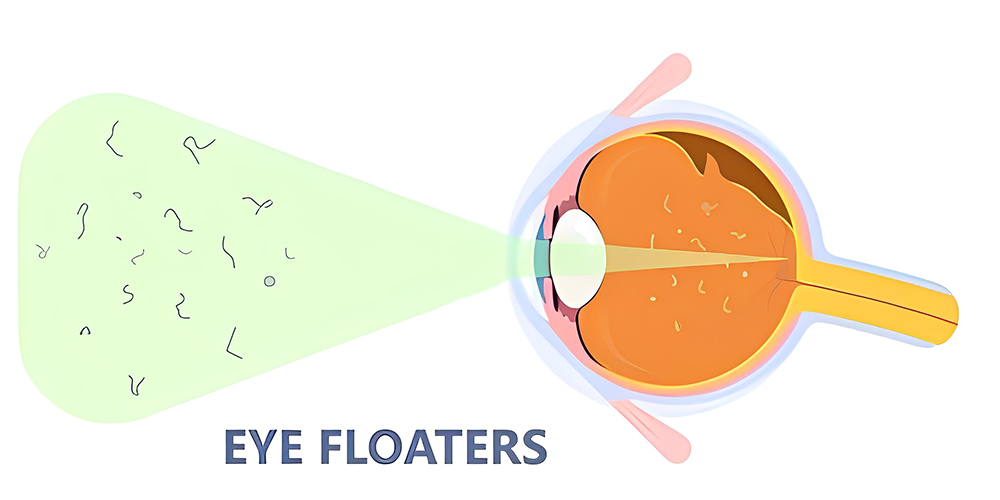 چه چیزی باعث ایجاد شناورهای چشمی می شود؟