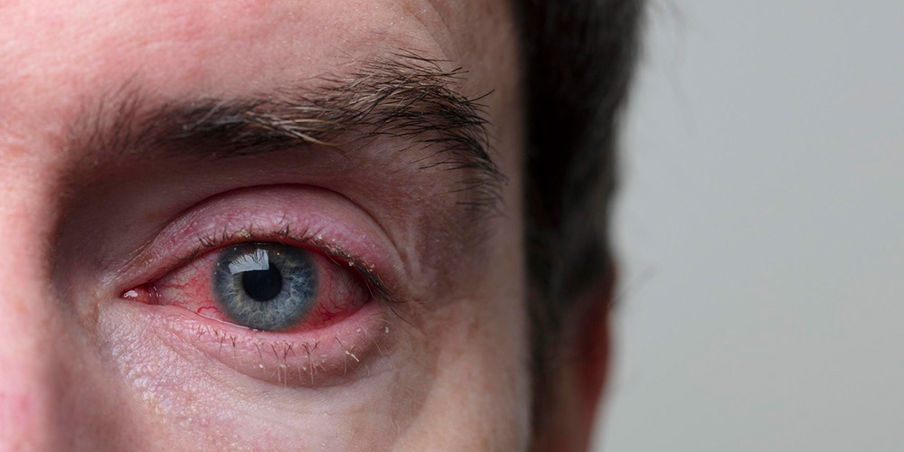بیماری چشم صورتی یکی از انواع بیماری های چشم