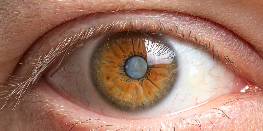 گلوکوم یکی از انواع بیماری های چشم