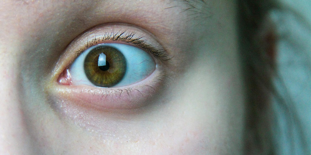 اتساع یا گشادی مردمک یکی از انواع بیماری های چشم است.