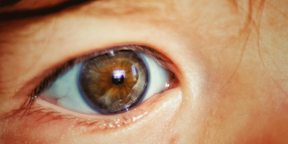 سرطان چشم: یکی از انواع بیماری های چشم