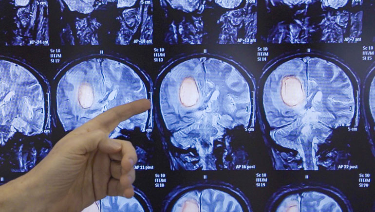 هیدروژلی که یکی از تهاجمی ترین انواع سرطان مغز را از بین می برد