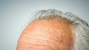 درمان جدید برای ریزش مو با استفاده از microRNA