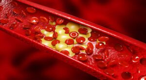علائم کلسترول بالا و راه های درمان چربی خون